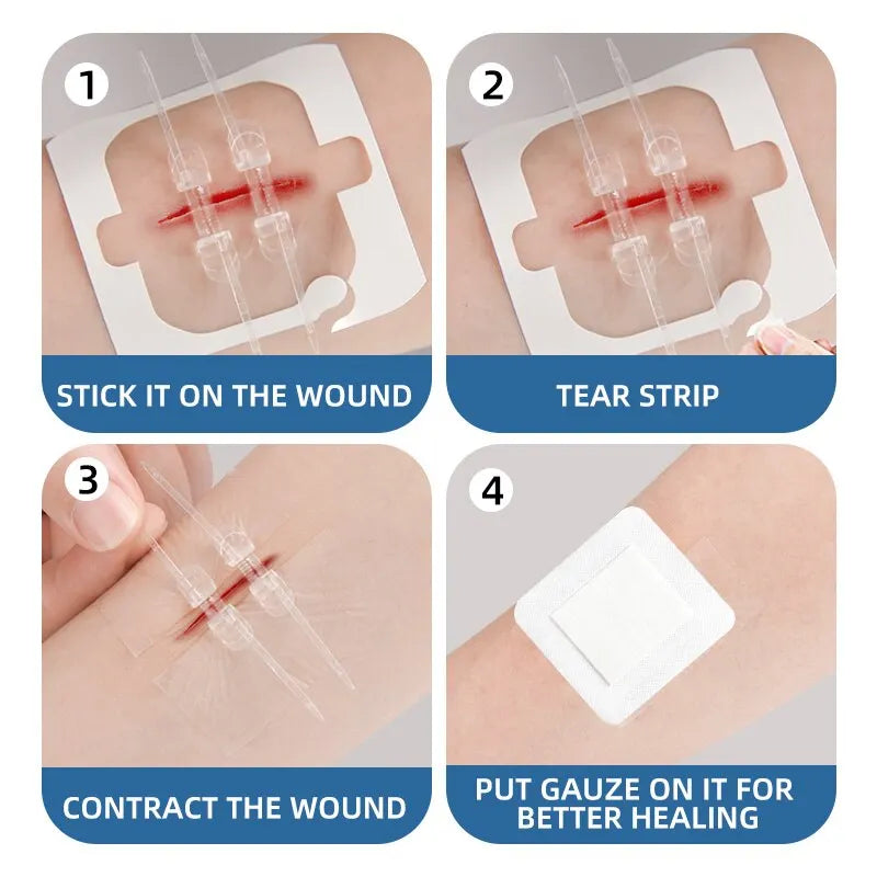 2x Pansements de Suture pour Plaie à Glissière