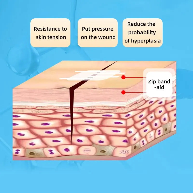 2x Pansements de Suture pour Plaie à Glissière