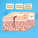 2x Pansements de Suture pour Plaie à Glissière